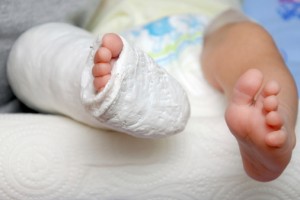 baby foot in cast