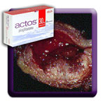 Actos Bladder Cancer