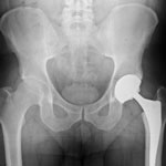 Zimmer Hip Replacement X ray