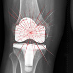 Zimmer knee replacement