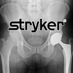 Stryker Hip Replacement 01