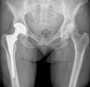 Hip Replacement Xray