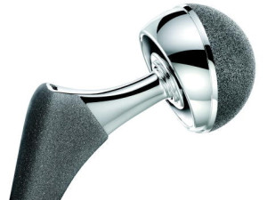 DePuy ASR Hip Implant