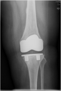 Zimmer Knee Replacement Complications