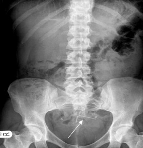 Mirena IUD migration xray