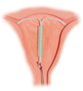 Mirena IUD