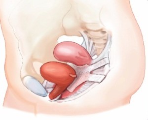 illustration of transvaginal mesh inserted