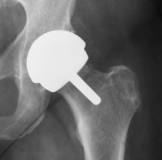 metal on metal hip implant xray