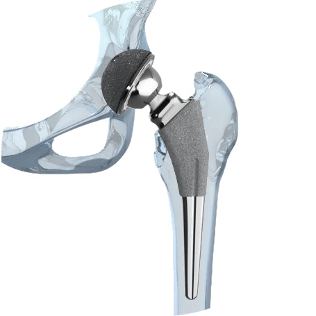 Zimmer Durom Cup Hip Implant