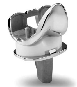 Recalled knee replacement component
