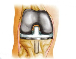 Zimmer knee replacement cross section illustration