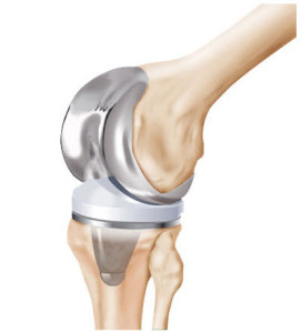 Knee Replacement Failure, Infection, Revision